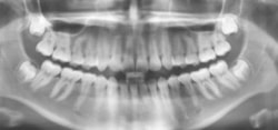 健康な歯の人のレントゲン写真