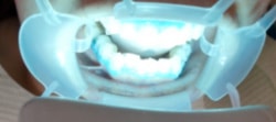 ビヨンドシステムによる歯のホワイトニング